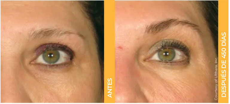Primer plano de antes y después de las cejas de una paciente real de Ultherapy<sup>&reg;</sup>, mostrando resultados de lifting después de 450 días.