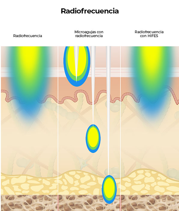 Diagrama que compara las terapias de radiofrecuencia con la penetración más profunda de Ultherapy<sup>&reg;</sup> en las capas de la piel.