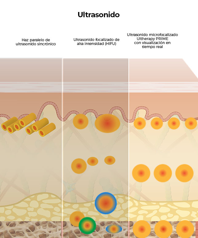 Diagrama que compara otros tratamientos de ultrasonido con la penetración más profunda de Ultherapy<sup>&reg;</sup> en las capas de la piel.
