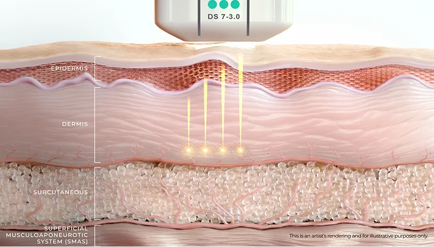 Diagrama de Ultherapy PRIME® que muestra ultrasonido microfocalizado creando puntos de coagulación térmica a profundidades precisas de la piel.