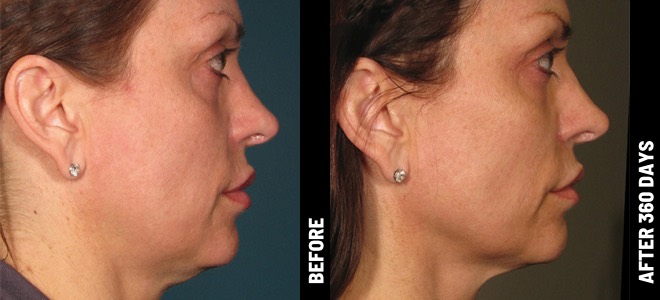 Imágenes de antes y después, lado a lado, que muestran resultados de lifting y firmeza de la piel post-Ultherapy. Diana, 62
