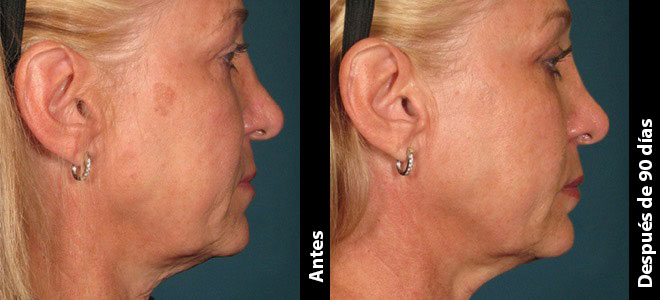 Imágenes de antes y después, lado a lado, que muestran resultados de lifting y firmeza de la piel post-Ultherapy. 