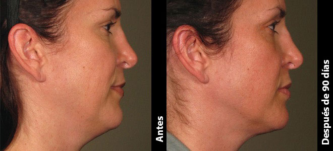 Imágenes de antes y después, lado a lado, que muestran resultados de lifting y firmeza de la piel post-Ultherapy. 