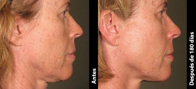 Imágenes de antes y después, lado a lado, que muestran resultados de lifting y firmeza de la piel post-Ultherapy. 