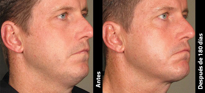 Imágenes de antes y después, lado a lado, que muestran resultados de lifting y firmeza de la piel post-Ultherapy. 
