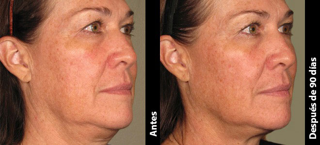 Imágenes de antes y después, lado a lado, que muestran resultados de lifting y firmeza de la piel post-Ultherapy. 