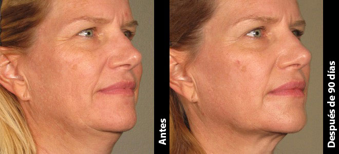 Imágenes de antes y después, lado a lado, que muestran resultados de lifting y firmeza de la piel post-Ultherapy. 