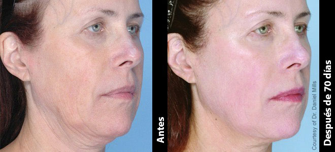 Imágenes de antes y después, lado a lado, que muestran resultados de lifting y firmeza de la piel post-Ultherapy. 