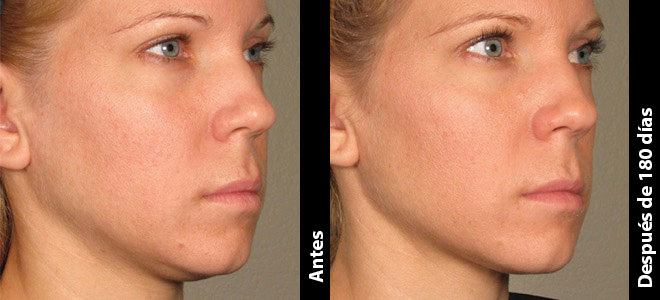Imágenes de antes y después, lado a lado, que muestran resultados de lifting y firmeza de la piel post-Ultherapy. 