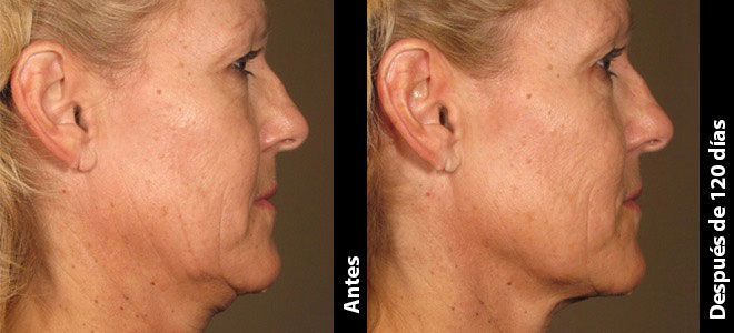 Imágenes de antes y después, lado a lado, que muestran resultados de lifting y firmeza de la piel post-Ultherapy. 