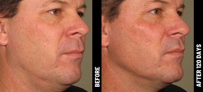 Imágenes de antes y después, lado a lado, que muestran resultados de lifting y firmeza de la piel post-Ultherapy. 